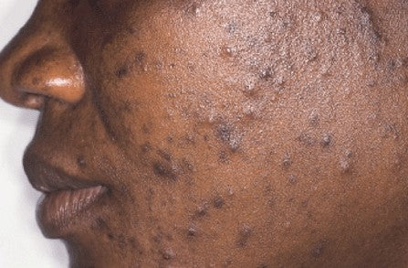 LED Light Therapy for Acne Treatment in Nairobi